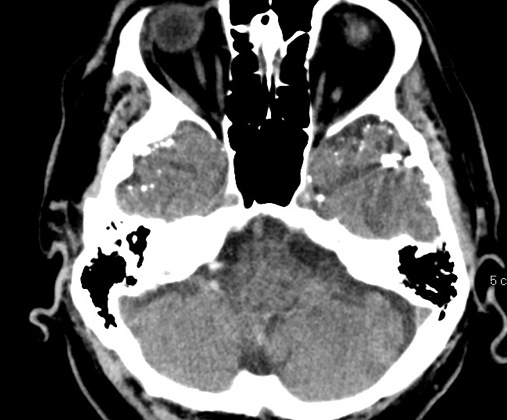 Figure 2 for case Lipiodol droplets after myelogram